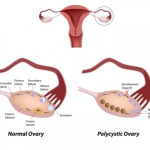 picture of normal ovaries, ovaries with ovarian cysts, cysts on the ovaries, polycystic ovaries