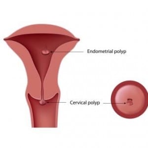 Address These 9 Causes of Uterine Polyps With a Naturopath
