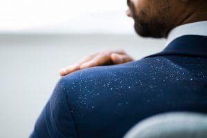 man brushing severe dandruff from his dry, itchy, flaky scalp off of his shoulders